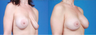 Revision Breast Surgery