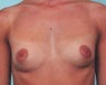 Breast Augmentation