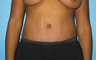 BeverlyHills Tummy Tuck