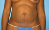 BeverlyHills Tummy Tuck