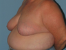 Underwent a Breast Reduction 