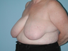 Underwent a Breast Reduction 