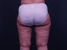 Liposuction Inner & Outer Thighs