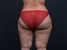 Liposuction Inner & Outer Thighs