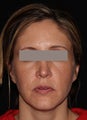 Female patient before and after Fraxel Dual.