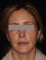 Female patient before and after Fraxel Dual.