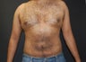 Liposuction of abdomen, flank and chest