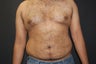 Liposuction of abdomen, flank and chest