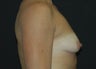 Breast Asymmetry 3