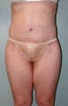 Female patient who received surgery after major weight loss 