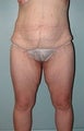Female patient who received surgery after major weight loss 