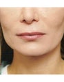 Lip Augmentation with Fat