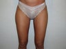 Liposuction of Thighs