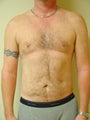 Laser Liposuction