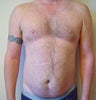 Laser Liposuction