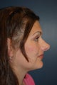 Revision Rhinoplasty