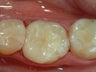 Replacing Silver Fillings