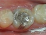 Replacing Silver Fillings