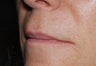 Juvederm upper lip lines and smile folds