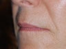 Juvederm upper lip lines and smile folds