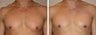 Male Breast Reduction