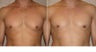 Male Breast Reduction