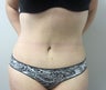 Tummy Tuck