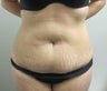 Tummy Tuck