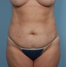 Tummy Tuck