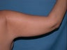 Arm Lift