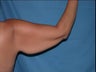 Arm Lift