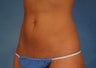 CoolSculpting