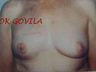 Breast Reconstruction