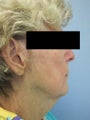 Woman, fillers used to lift cheeks