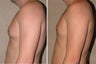 Gynecomastia