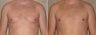 Gynecomastia