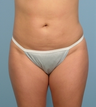 Liposuction