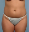 Liposuction