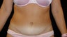Tummy Tuck
