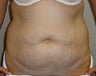 Tummy Tuck