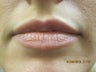 26 Year Old Female Treated for Lip Enhancement