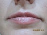 26 Year Old Female Treated for Lip Enhancement