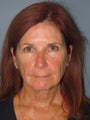 Neck Lift on 61-year-old