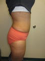Tummy Tuck