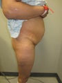 Tummy Tuck