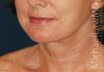 Neck Lift