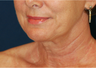 Neck Lift