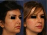Rhinoplasty revision