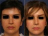 Rhinoplasty revision