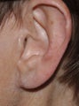 65 Year Old Female Treated For Big Earlobes With Wrinkles